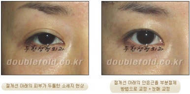 [Duhan Plastic Surgery Double Eyelid Revision Surgery] - [Ptosis, sausage eyelids] image 30