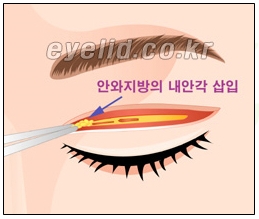 [두한성형외과 쌍꺼풀재수술] - [쌍꺼풀재수술성공요건, 쌍꺼풀재수술과정] 관련 이미지 14