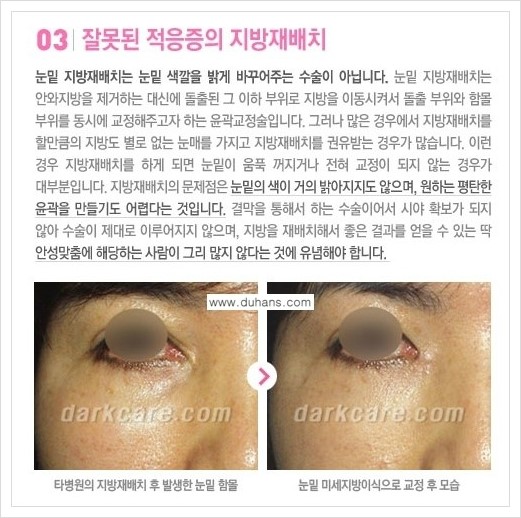 [두한성형외과 경쟁력 눈밑 다크써클 치료] - [다크써클 치료 실패의 원인 분석 안내] 관련 이미지 7