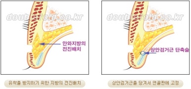[Duhan Plastic Surgery Double Eyelid Revision Surgery] - [Ptosis, sausage eyelids] image 12