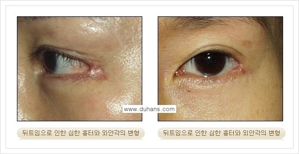 [두한성형외과 경쟁력 있는 쌍꺼풀 재수술] - [뒤트임 수술] 관련 이미지 5