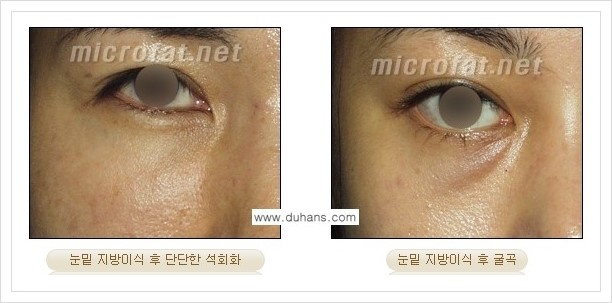 ⁠[두한성형외과 경쟁력 미세지방이식] - [미세지방이식의 부작용 문제 교정 안내] 관련 이미지 8