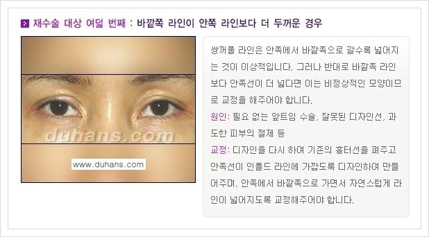 [두한성형외과 경쟁력 쌍꺼풀 재수술(극한 재수술)] - [쌍꺼풀 재수술 대상의 안내] 관련 이미지 8