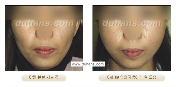 [두한성형외과 경쟁력 미세지방이식] - [탄력있는 피부와 윤곽을 만들어주는 Col-fat 지방이식] 관련 이미지 16