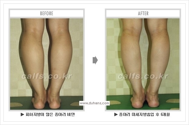 [두한성형외과 경쟁력 멀티종아리성형] - [종아리성형 방법별 전후 주의사항] 관련 이미지 25