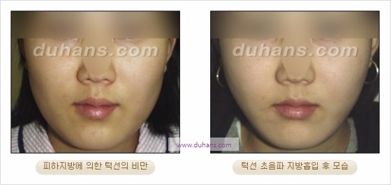 [두한성형외과 경쟁력 지방흡입] - [볼살, 턱선의 간편 지방흡입] 관련 이미지 16