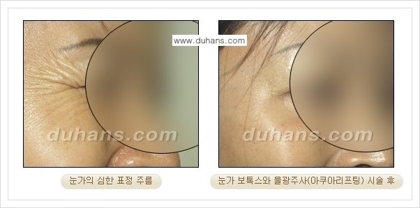 [두한성형외과 경쟁력 주름성형] - [미간주름, 눈가주름, 눈밑주름 제거 시술 안내] 관련 이미지 3