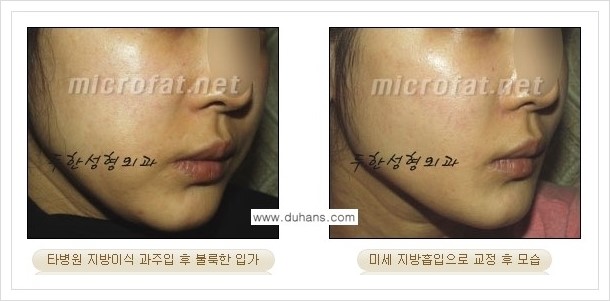 [두한성형외과의 경쟁력 지방이식] - [볼살 지방이식 부작용 -  지방이식 후 과주입으로 인해 불룩해진 경우] 관련 이미지 2