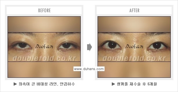 [두한성형외과 쌍꺼풀 재수술] - [지나친 아웃폴드 라인의 쌍꺼풀 재수술] 관련 이미지 4