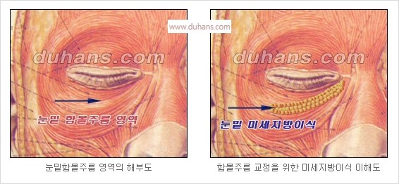 [두한성형외과 경쟁력 안검성형] - [젊은 눈매 안검성형의 여러 가지 방법 안내] 관련 이미지 69