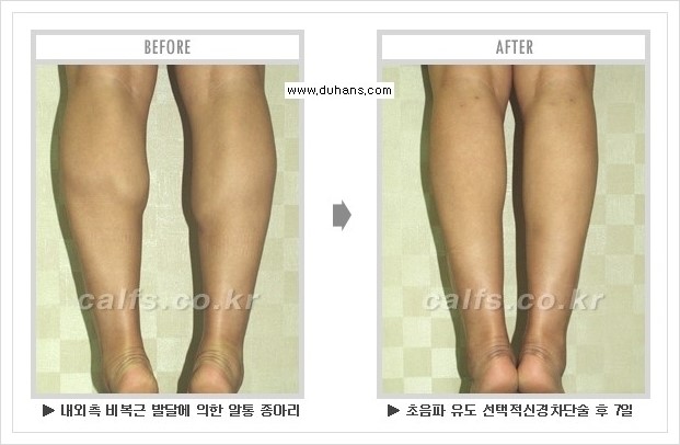 [두한성형외과 경쟁력 멀티종아리성형] - [종아리성형 방법별 전후 주의사항] 관련 이미지 15