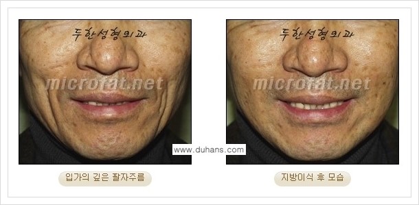 [두한성형외과 경쟁력 지방이식] - [입가주름, 팔자주름 미세지방이식의 안내] 관련 이미지 16