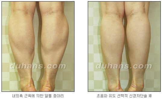 [Duhan Plastic Surgery Calf Reduction] - [How to Get Rid of Calf Muscle Bulges] image 21