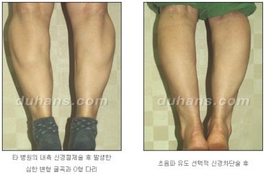 [두한성형외과 종아리 퇴축] - [종아리 퇴축술 재발 재수술] 관련 이미지 26