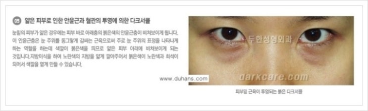 [두한성형외과 경쟁력 눈밑성형] - [다크써클의 종류] 관련 이미지 6