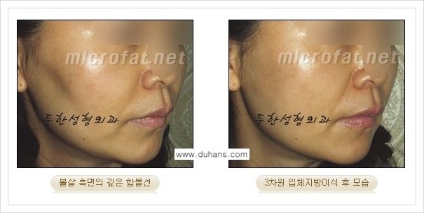 [두한성형외과 경쟁력 윤곽성형] - [볼, 볼살 지방이식] 관련 이미지 24