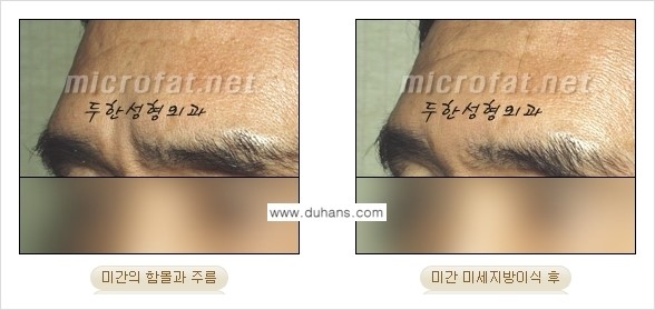 [두한성형외과 경쟁력 미세지방이식] - [두한성형외과 Col-fat(콜펫) 지방이식으로 교정이 가능한 부위 안내] 관련 이미지 4