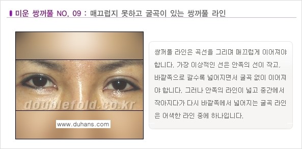 [두한성형외과 경쟁력 눈성형] - [미운 쌍꺼풀이란?] 관련 이미지 10