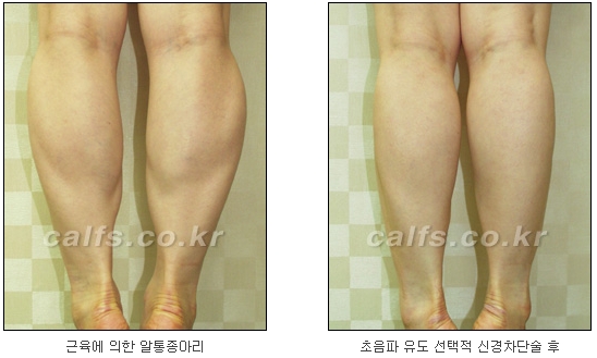 ​[두한성형외과 종아리성형] - [나에게 맞는 종아리시술] 관련 이미지 8