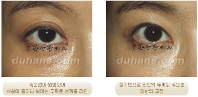 두한성형외과 눈재수술 - 쌍꺼풀 재수술 방법 관련 이미지 42