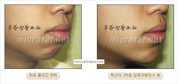 [두한성형외과 경쟁력 미세지방이식] - [부드럽고 아름다운 얼굴윤곽선 턱(하악부) 미세지방이식 안내] 관련 이미지 19