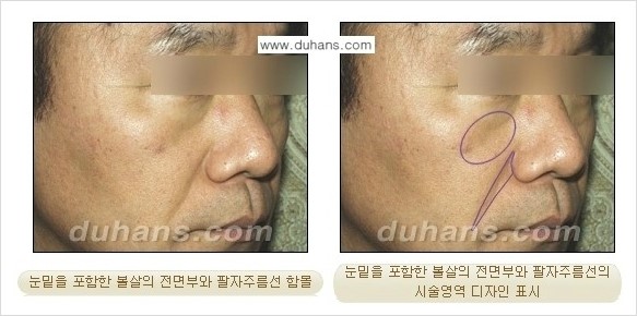 [두한성형외과 경쟁력 미세지방이식] - [귀족수술 입체 미세지방이식] 관련 이미지 6