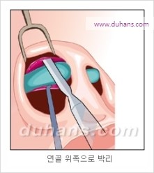 [두한성형외과 경쟁력 코성형 리더] - [자연스럽고 오똑한 콧망울! 코성형 방법]​ 관련 이미지 5