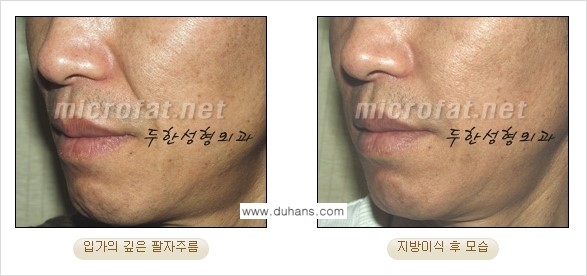 [두한성형외과의 경쟁력 있는 지방이식] - [입가주름, 팔자주름 미세지방이식 1.] 관련 이미지 8