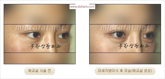 ​﻿[두한성형외과 경쟁력 지방이식] - [눈밑 애교살 시술을 위한 미세지방이식] 관련 이미지 43