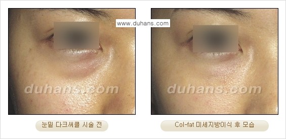 [두한성형외과 경쟁력 미세지방이식] - [탄력있는 피부와 윤곽을 만들어주는 Col-fat 지방이식] 관련 이미지 10