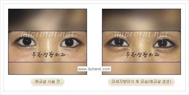 [두한성형외과 경쟁력 눈밑성형] - [애교살과 다크써클과의 관계] 관련 이미지 17