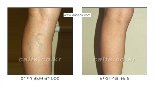 [두한성형외과 경쟁력 멀티종아리성형] - [나에게 맞는 종아리 시술 방법과 종류 안내 ③] 관련 이미지 15