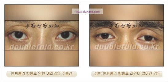 [두한성형외과 경쟁력 눈성형] - [눈꺼풀이 꺼진 경우의 쌍꺼풀 라인을 교정하기 위한 미세지방이식] 관련 이미지 4
