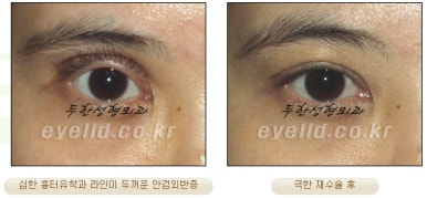 Duhan Plastic Surgery Ophthalmic Reoperation - What Is a Successful Double Eyelid Revision Surgery? image 18