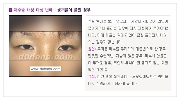 [두한성형외과 경쟁력 쌍꺼풀 재수술(극한 재수술)] - [쌍꺼풀 재수술 대상의 안내] 관련 이미지 5