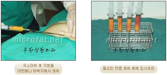 [Duhan Plastic Surgery Facial Fat Grafting] - [Fat Grafting Rhinoplasty] image 4