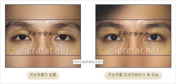 [두한성형외과 경쟁력 미세지방이식] - [꺼진(함몰된) 윗눈꺼풀 미세지방이식] 관련 이미지 11