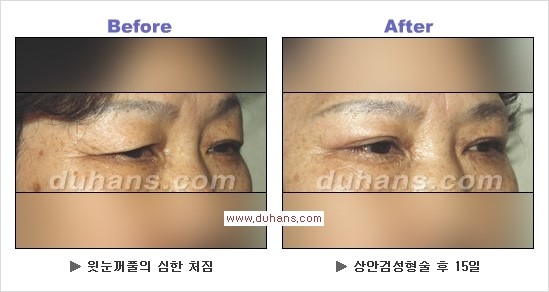 [두한성형외과 경쟁력 안검성형] - [젊고 아름다운 눈매 상안검 성형술 안내] 관련 이미지 10