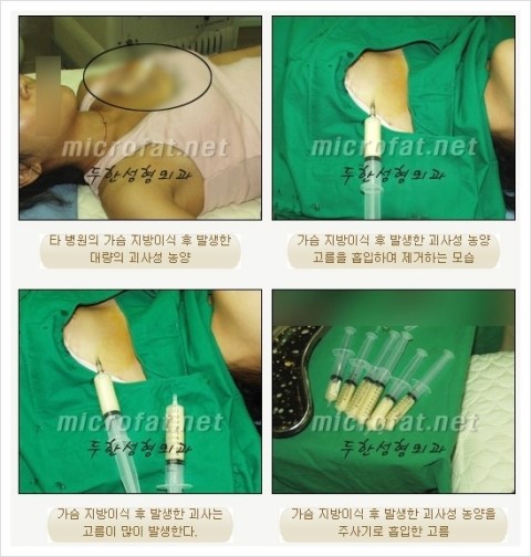 [두한성형외과 경쟁력 이마성형] - [이마 미세지방이식, 이마 엔도타인 리프팅]​ 관련 이미지 15