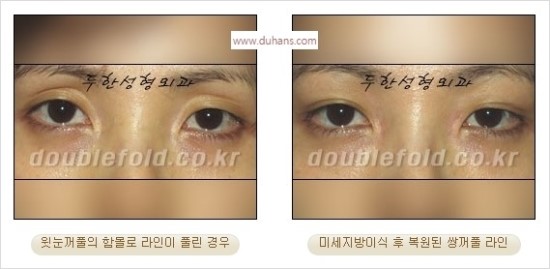 [두한성형외과 경쟁력 눈성형] - [쌍꺼풀 재수술 과정과 쌍꺼풀 재수술 실패의 원인, 쌍꺼풀 재수술의 성공 요건] 관련 이미지 50