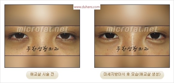 ​﻿[두한성형외과 경쟁력 지방이식] - [눈밑 애교살 시술을 위한 미세지방이식] 관련 이미지 37