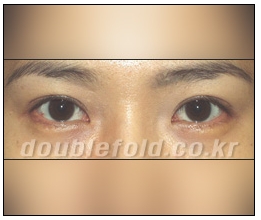 [Dohan Plastic Surgery Double Eyelid Surgery] - [Beautiful Double Eyelids] image 9