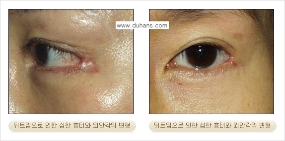 [두한성형외과 경쟁력 눈성형] - [뒤트임 수술 안내] 관련 이미지 4