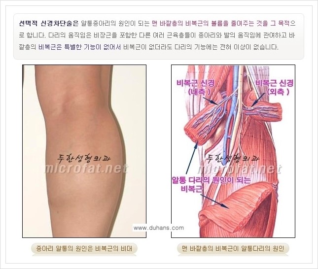 ⁠⁠⁠[두한성형외과 경쟁력 멀티종아리성형] - [굵은 알통 종아리 수술 안내 1.] 관련 이미지 5