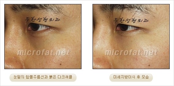 [두한성형외과 경쟁력 눈밑성형 리더] - [윗눈꺼풀 지방제거, 눈밑지방제거, 눈밑지방재배치, 눈밑지방이식 안내] 관련 이미지 24