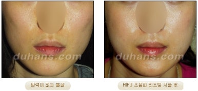 두한성형외과 주름개선 - 주름 HIFU 리프팅 관련 이미지 22