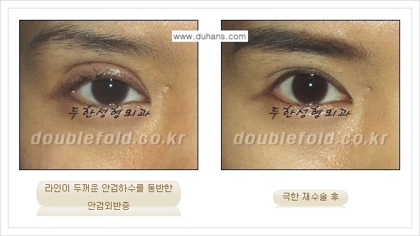 [두한성형외과 경쟁력 쌍꺼풀 재수술, 극한 재수술] - [망친 눈(쌍꺼풀) 복원수술과 일반 쌍꺼풀 재수술과의 차이점] 관련 이미지 7