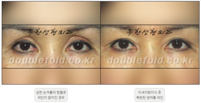 [두한성형외과 쌍커풀재수술] - [풀린 쌍커풀라인 교정] 관련 이미지 18