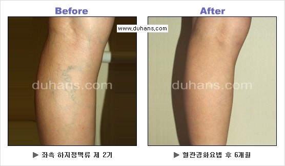 [두한성형외과 경쟁력 정맥류 치료] - [정맥류 치료의 모든 것] 관련 이미지 20