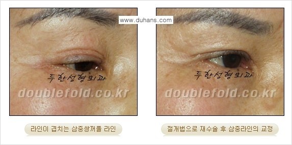 ⁠[두한성형외과 경쟁력 쌍꺼풀 재수술, 극한 눈재수술] - [삼중(세겹) 쌍꺼풀 라인의 교정] 관련 이미지 10